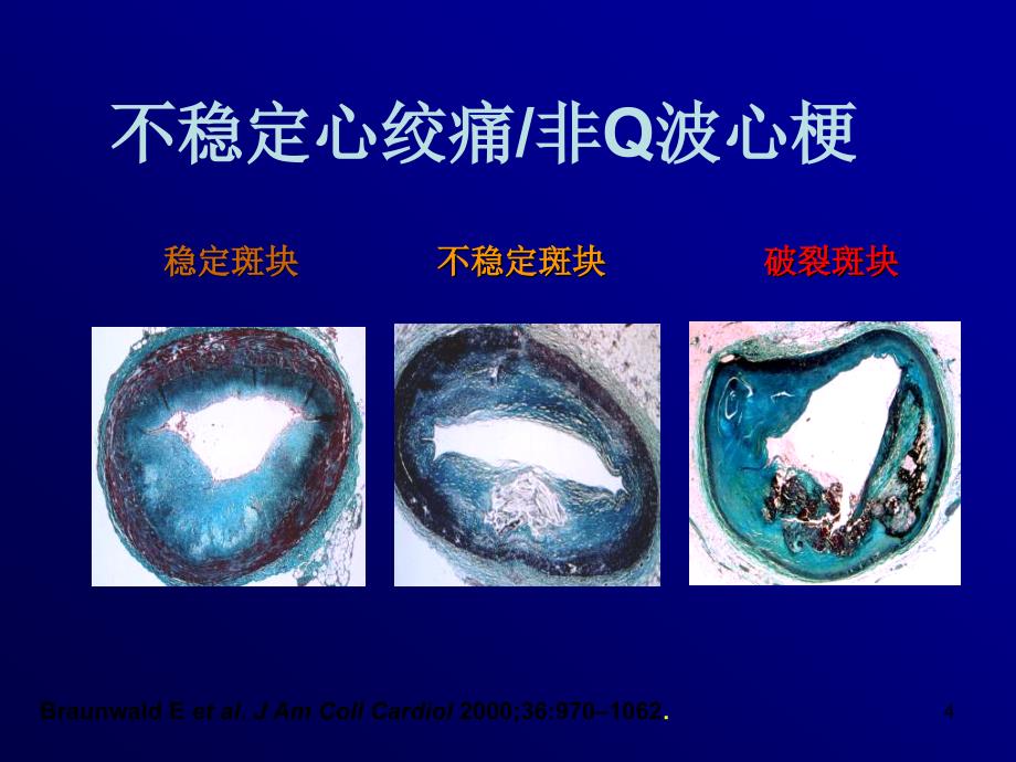 怎样战胜冠心病_第4页