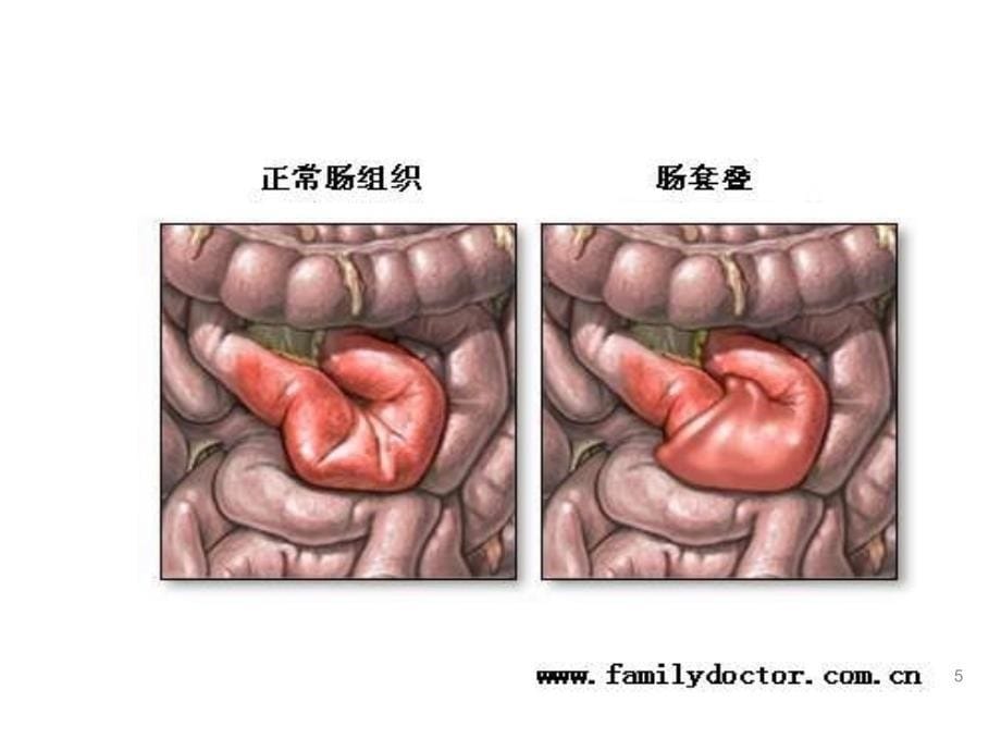 肠套叠护理查房_第5页