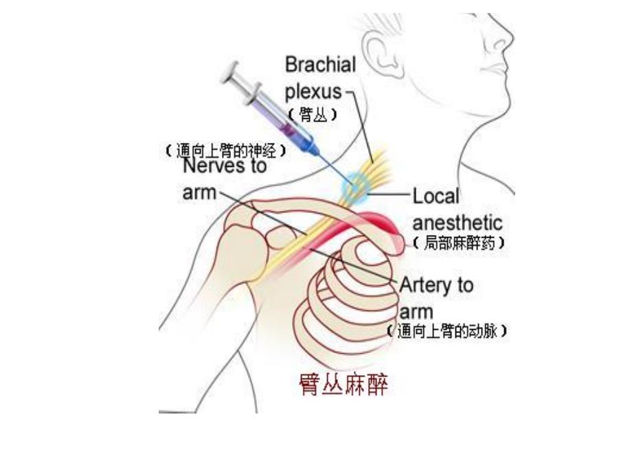 外周神经阻滞PPT课件_第4页