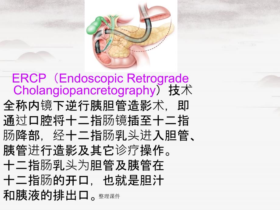 ercp术及相关护理_第2页