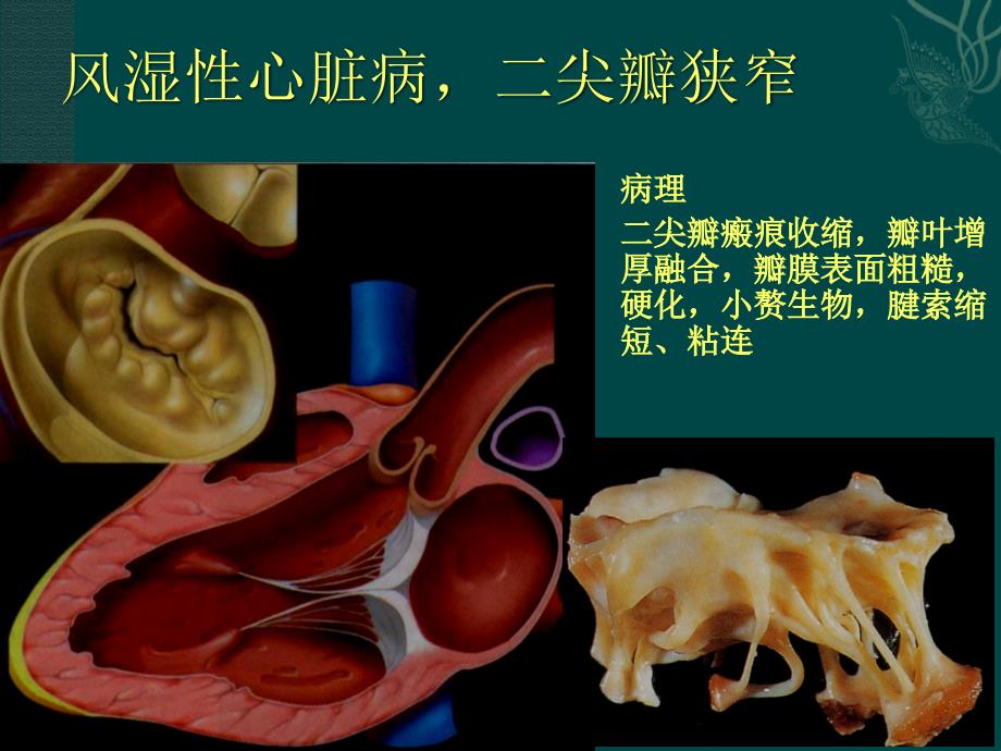 心肺影像诊断学：实习课二 二尖瓣病变、先天性心脏病、冠心病_第4页