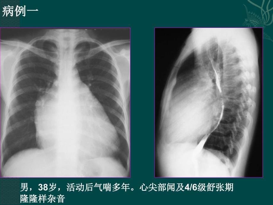 心肺影像诊断学：实习课二 二尖瓣病变、先天性心脏病、冠心病_第5页