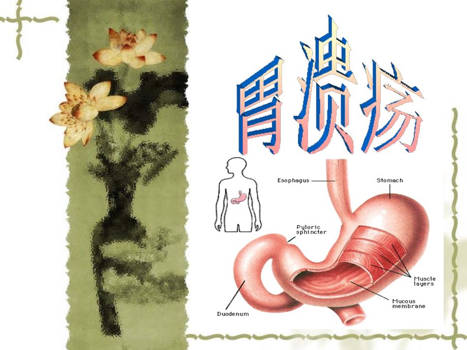 胃溃疡PPT课件_第1页