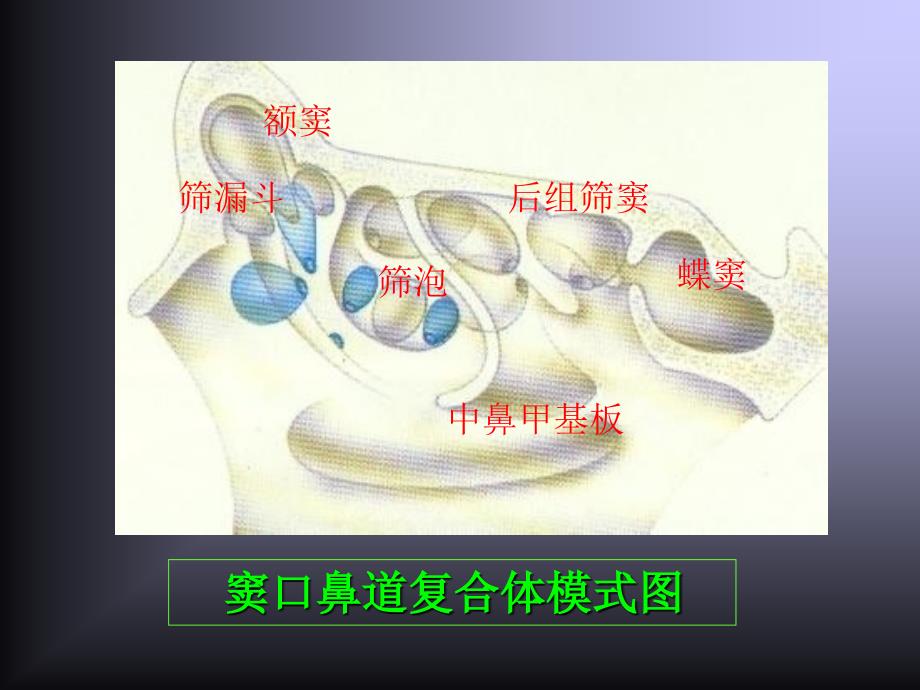 鼻腔鼻窦解剖变异与鼻窦炎发病和手术的关系_第4页