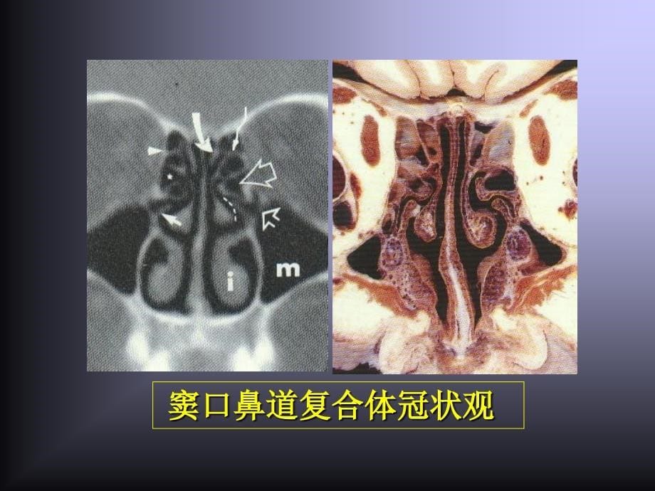 鼻腔鼻窦解剖变异与鼻窦炎发病和手术的关系_第5页