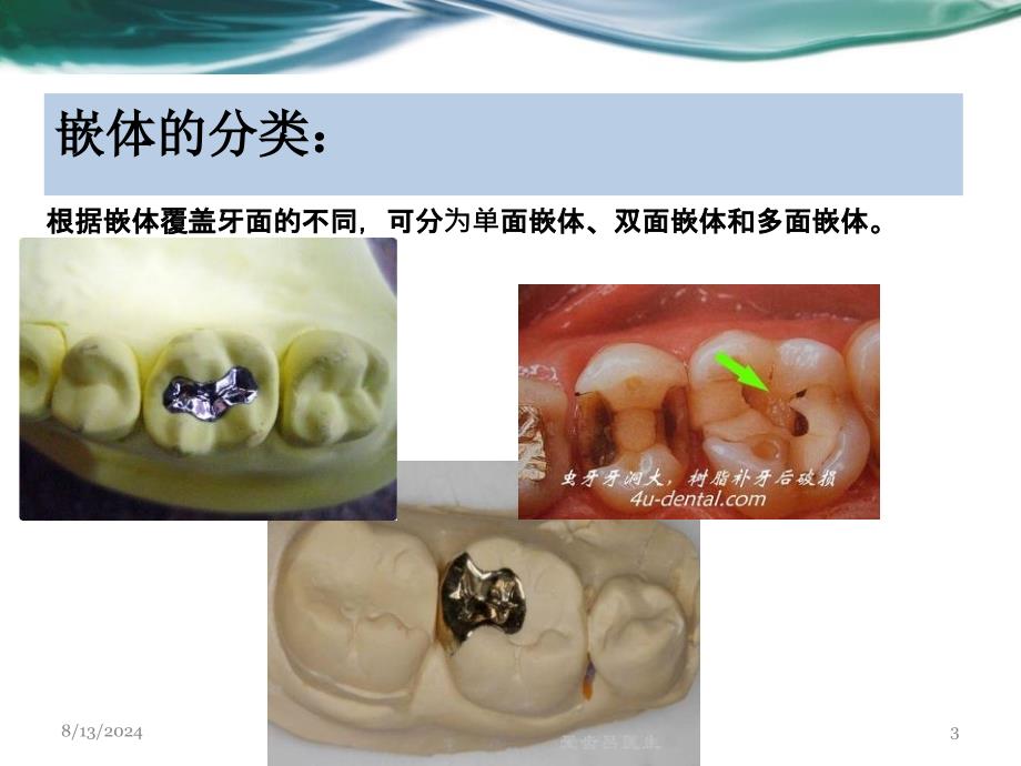 牙体缺损的嵌体修复ppt参考课件_第3页