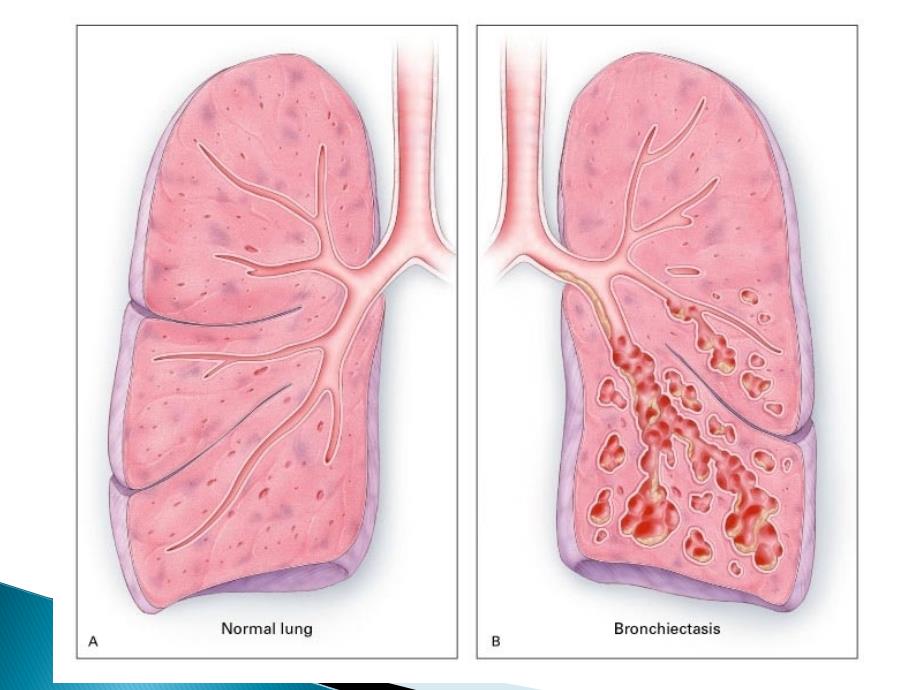 内科学：支气管扩张_第3页