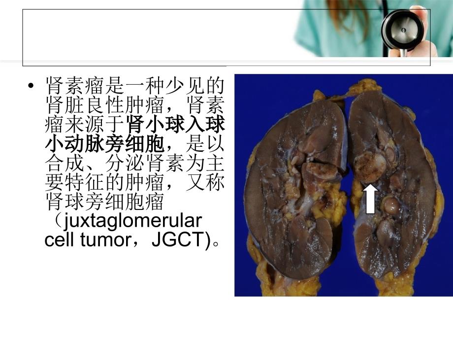 肾素瘤PPT课件_第2页