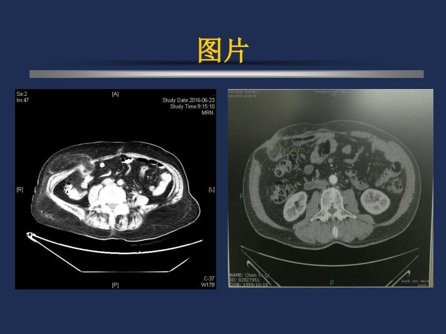 造口旁疝的预防和外科治疗.ppt_第5页