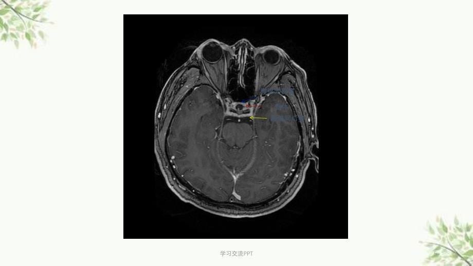 海绵窦解剖和常见疾病影像诊断课件_第5页