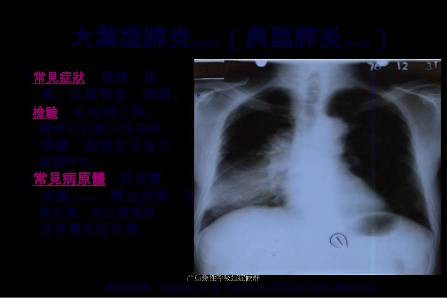 严重急性呼吸道症候群课件_第2页