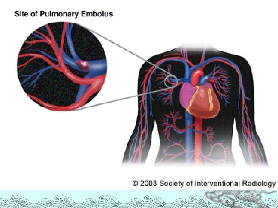 肺栓塞课件ppt演示课件_第5页