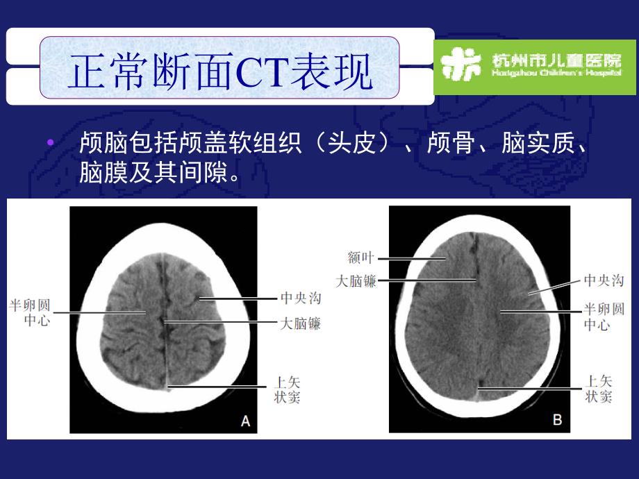 颅脑常见疾病CT表现_第4页