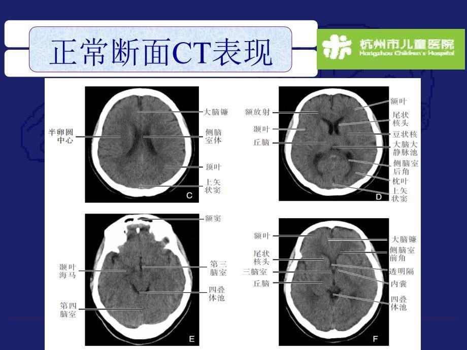 颅脑常见疾病CT表现_第5页