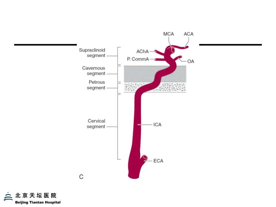 脑血管定位诊断_第4页