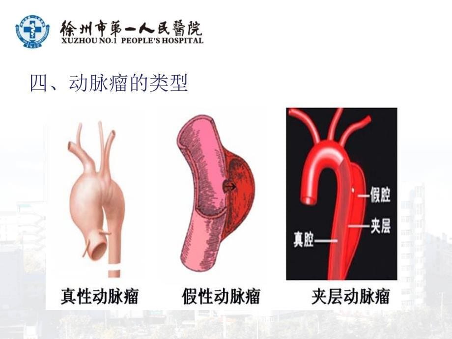 动脉瘤的护理--ppt课件_第5页