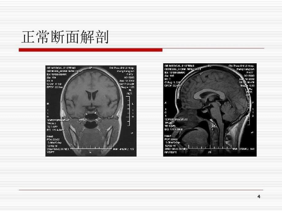 鞍区占位性病变的影像课件_第5页