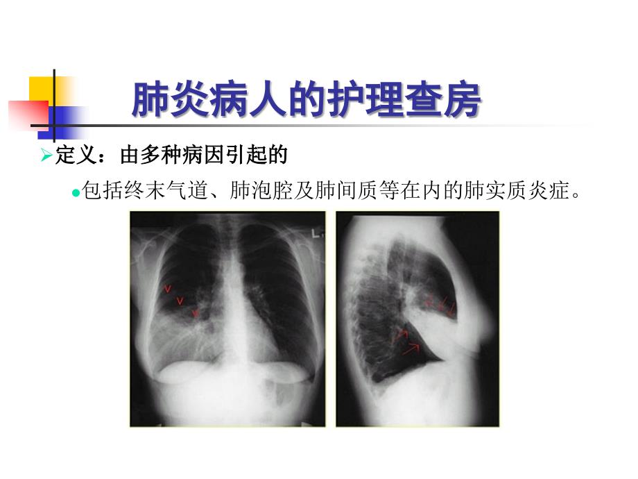 肺炎病人的护理查房_第4页