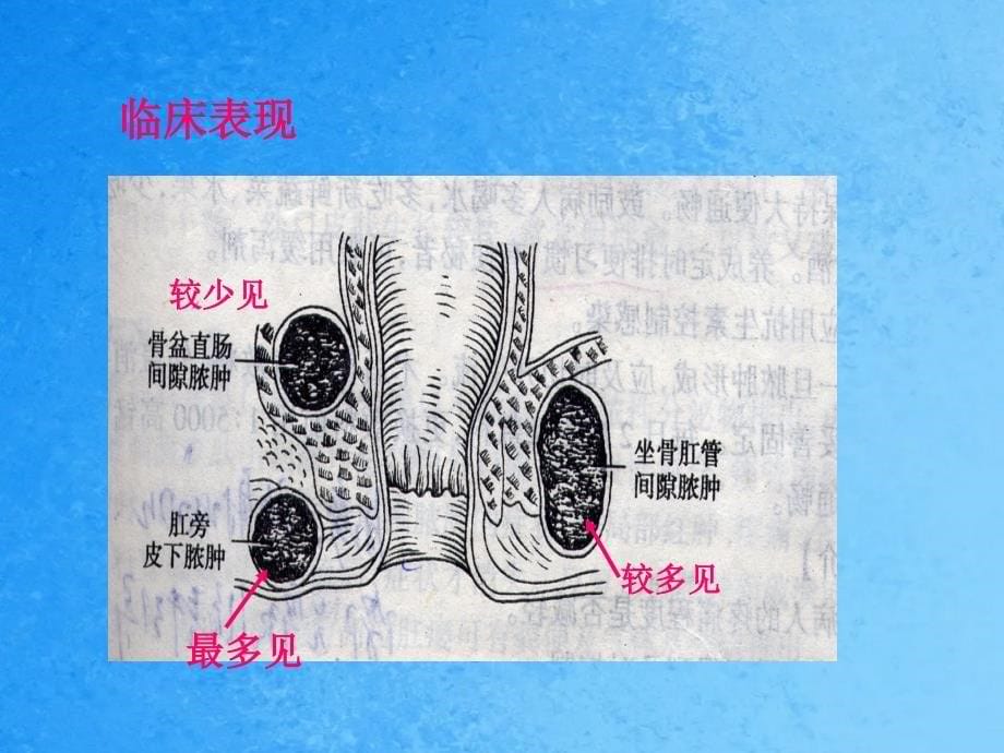 大肠肛管疾病护理ppt课件_第5页