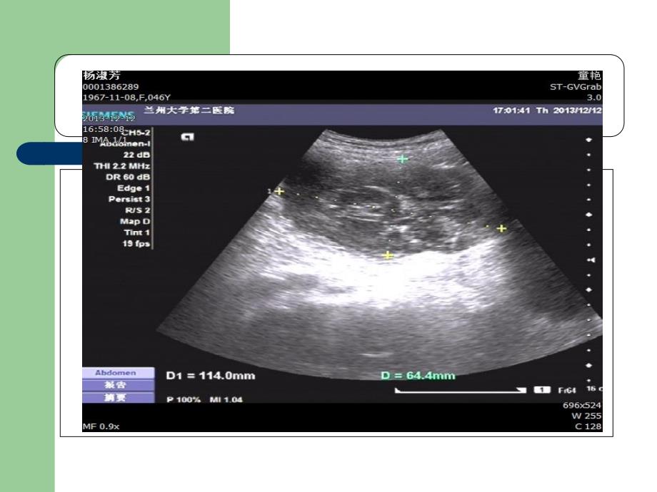 脐尿管囊肿超声诊断31页PPT课件_第4页