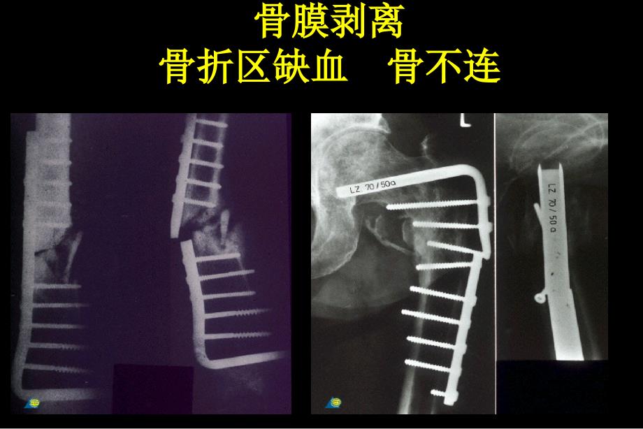 lcp内固定原则_第3页