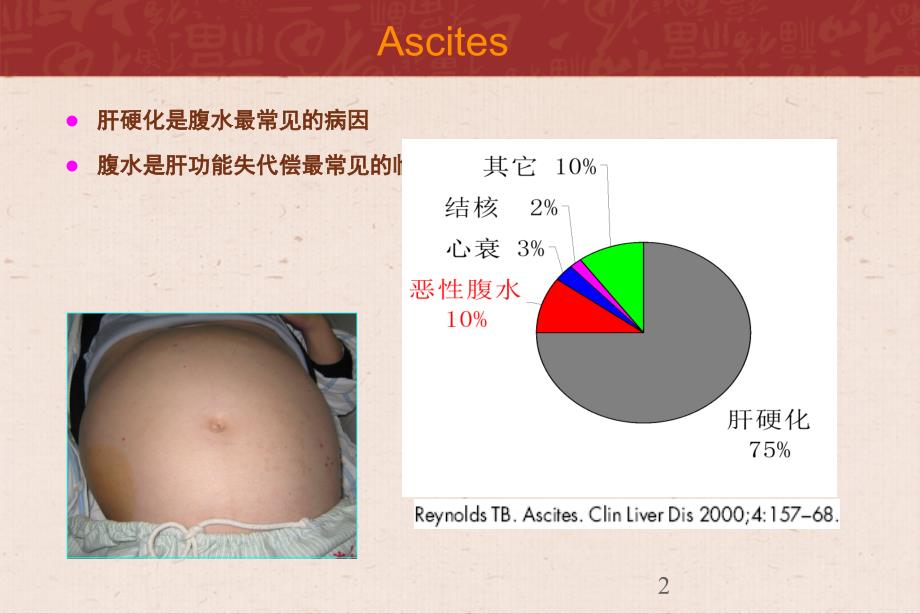 肝腹水的规范性诊治ppt课件_第2页