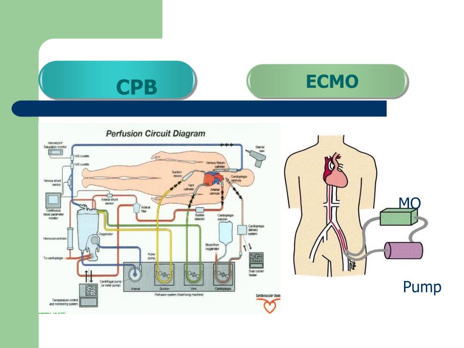 ecmo呼吸循环衰竭的应用课件 ppt课件_第4页