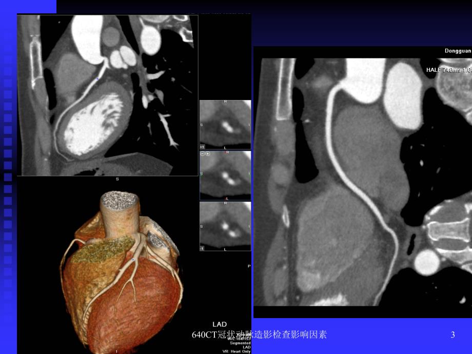 最新640CT冠状动脉造影检查影响因素_第3页
