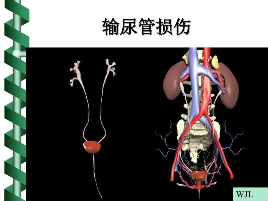 妇科手术泌尿系损伤_第5页