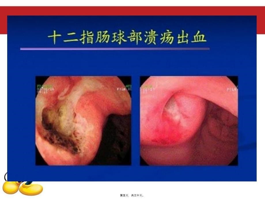 医学专题—上消化道出血的护.23264_第5页