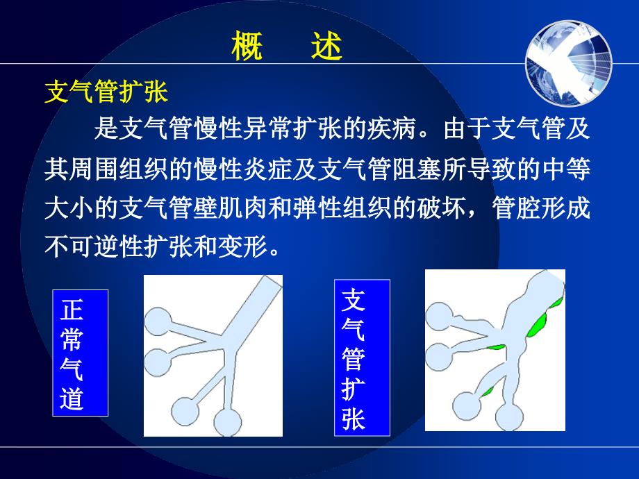 支气管扩张伴咯血咯血课件_第4页