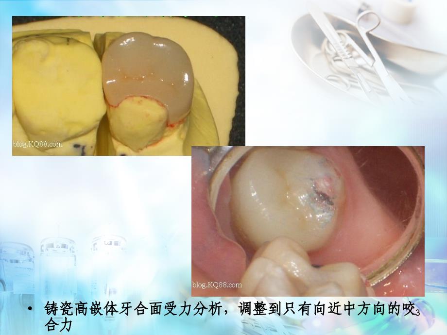 口腔修复病例讨论_第3页