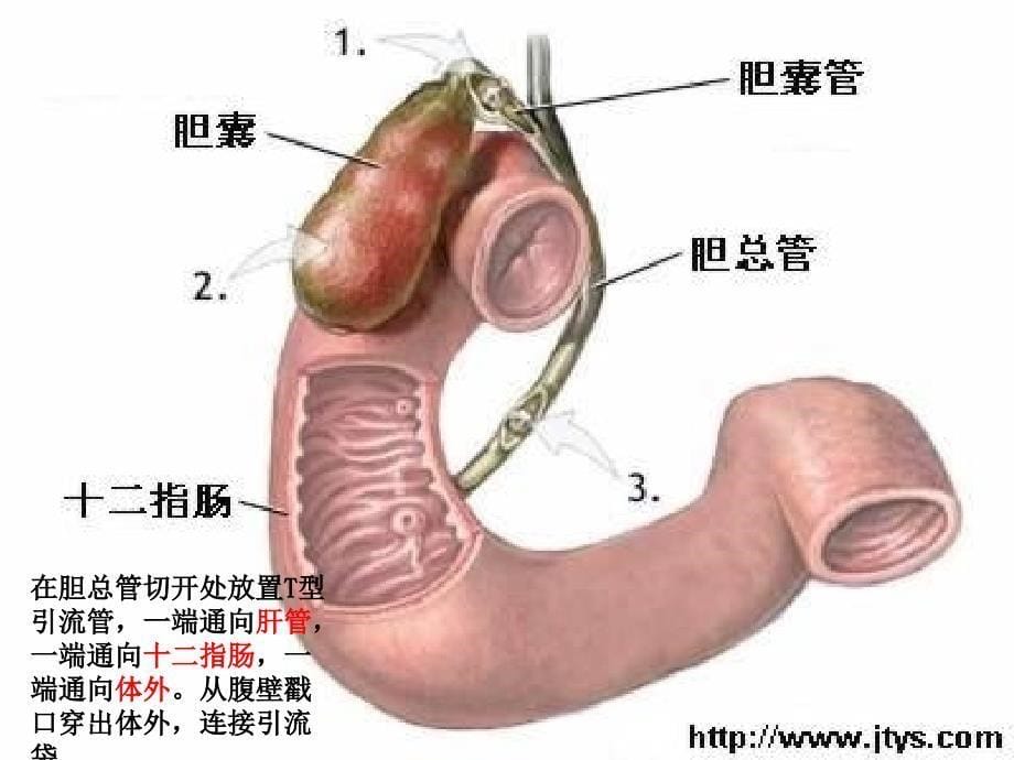 T管引流的护理_第5页