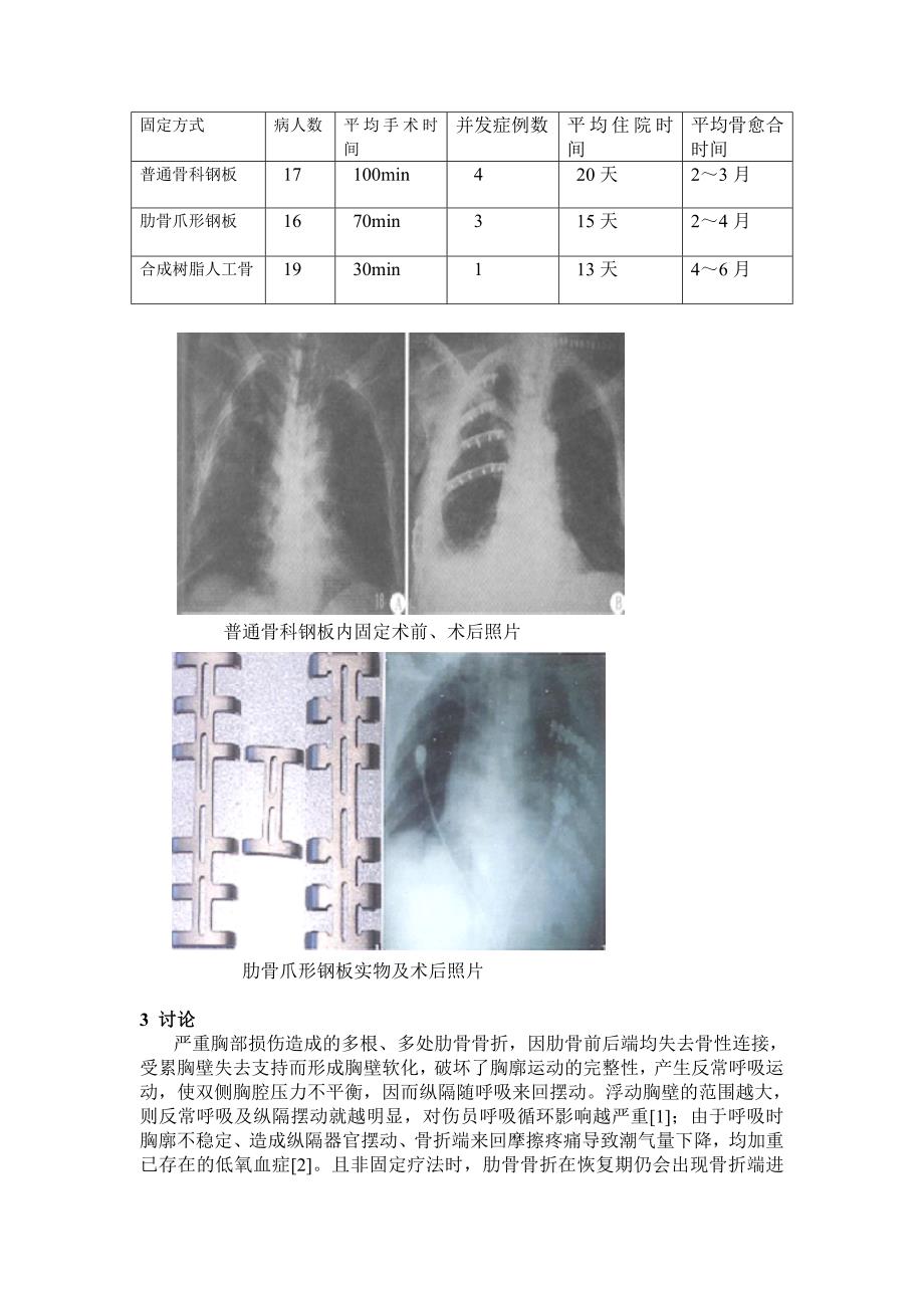 多发肋骨骨折内固定临床应用比较.doc_第3页