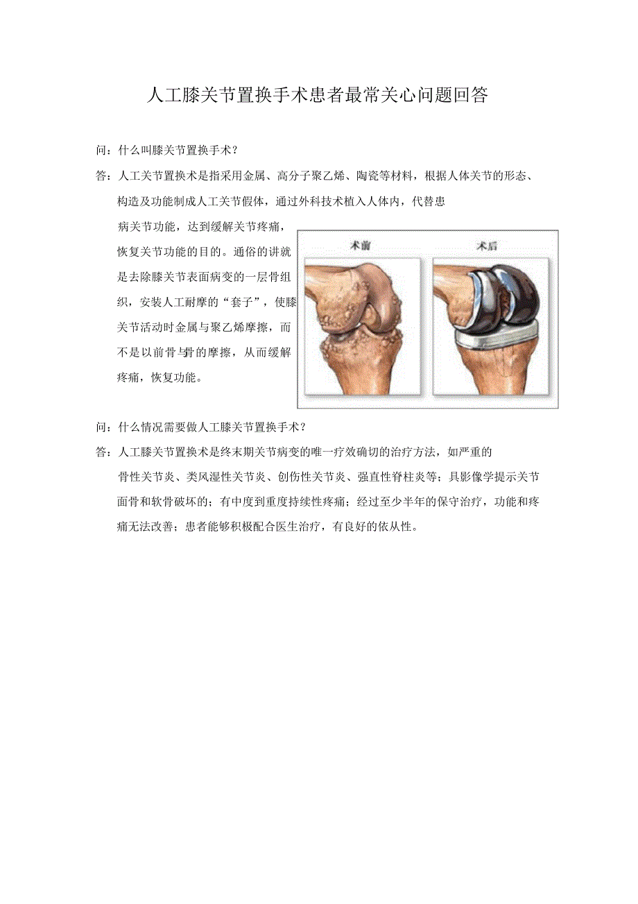 人工膝关节置换术宣教手册_第1页