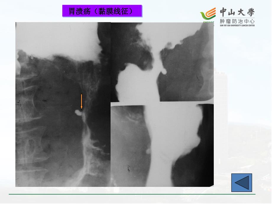 医学影像学：胃肠病变及急腹症_第4页