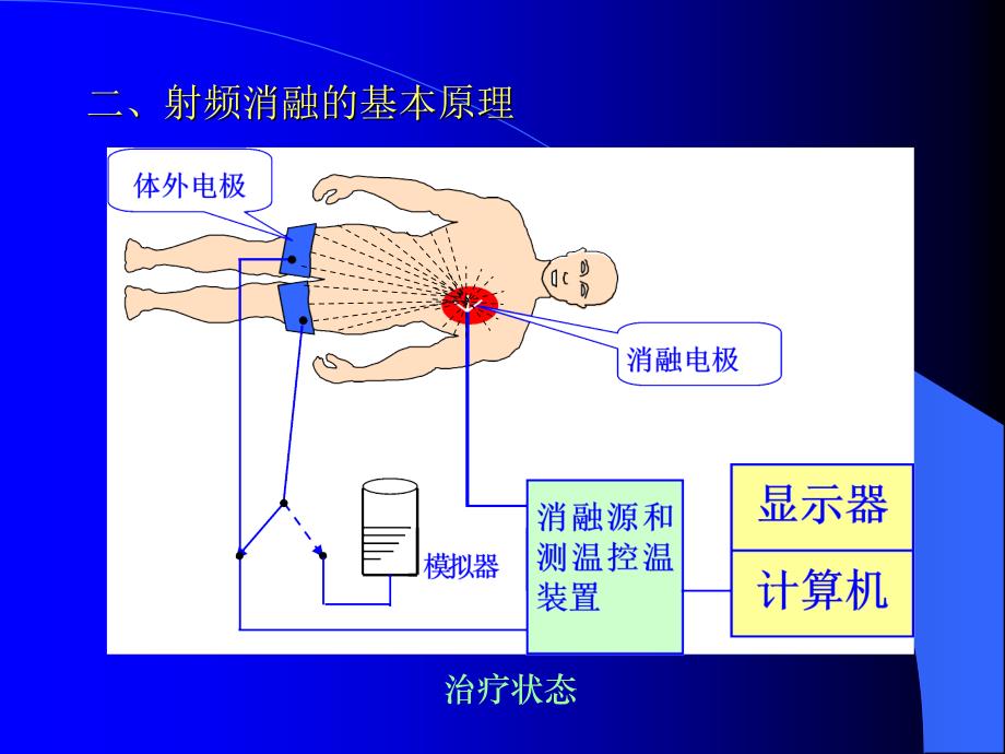 肿瘤介入诊疗中射频消融术的应用与展望_第4页