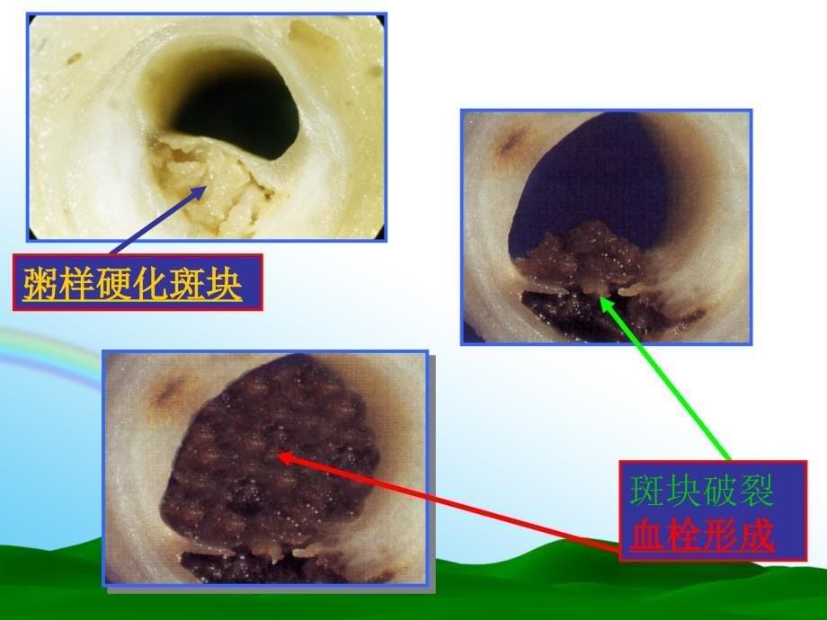 心绞痛的药物治疗_第5页