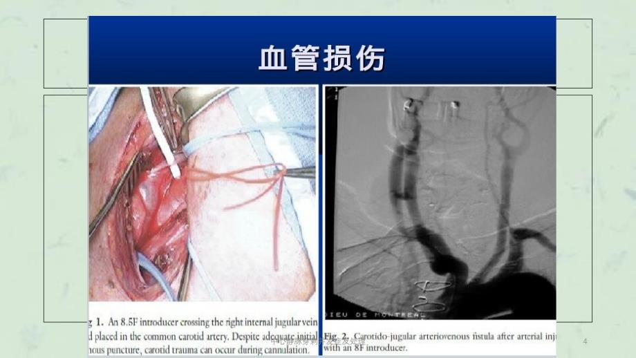 中心静脉穿刺并发症及处理课件_第4页