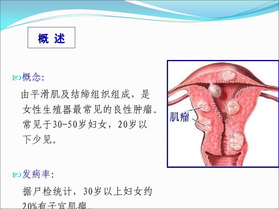 子宫肌瘤课件ppt课件_第2页