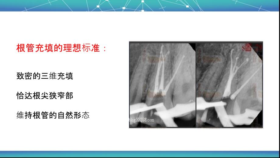 根管治疗术五根管充填_第3页