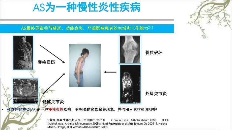 强直性脊柱炎的诊断与治疗进展_第5页