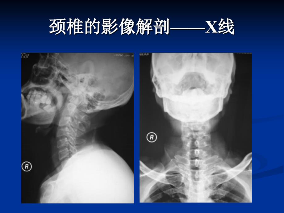 颈腰椎退行性疾病的影像学表现_第3页