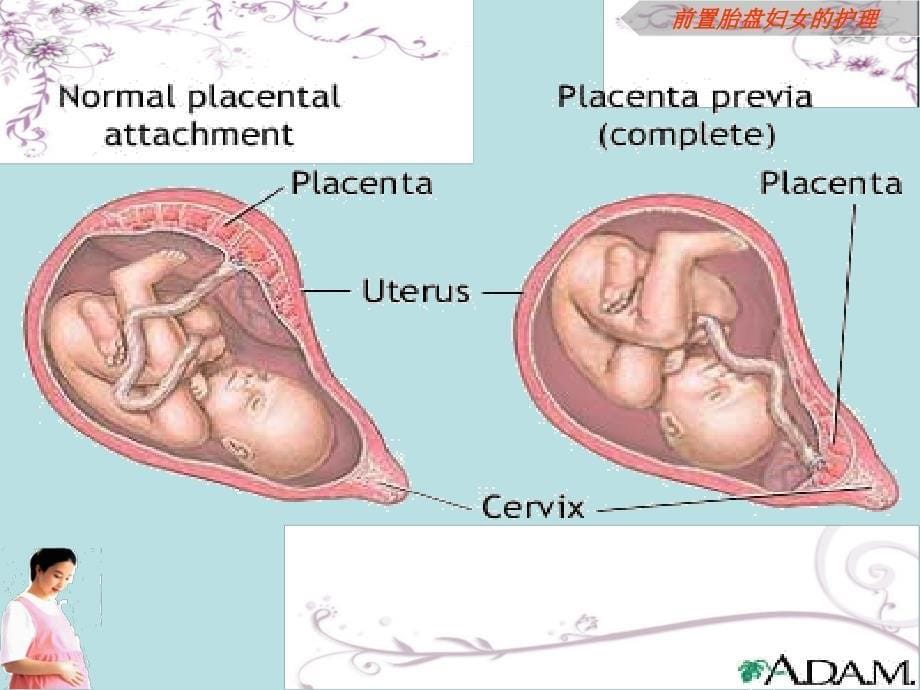 前置胎盘护理精选文档_第5页