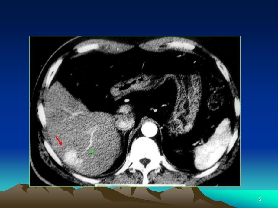 CT临床应用及新进展ppt参考课件_第5页