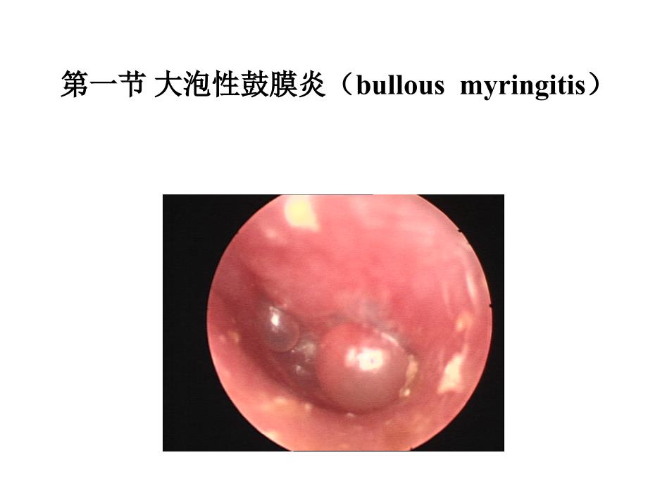 大泡性鼓膜炎_第1页