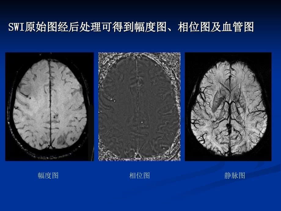 MR磁敏感加权成像课件_第5页