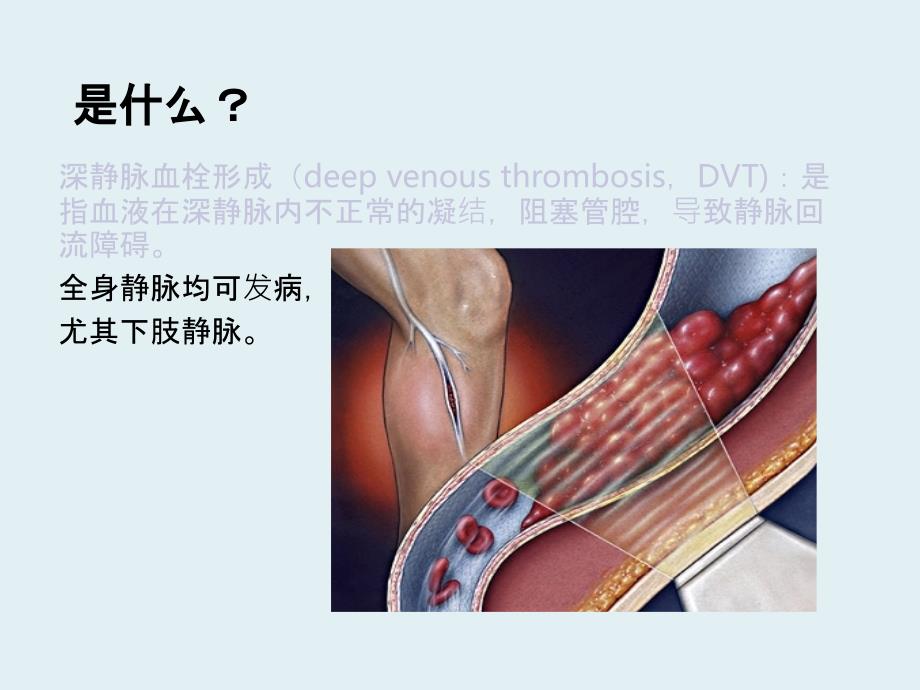 深静脉血栓健康宣教ppt课件_第3页