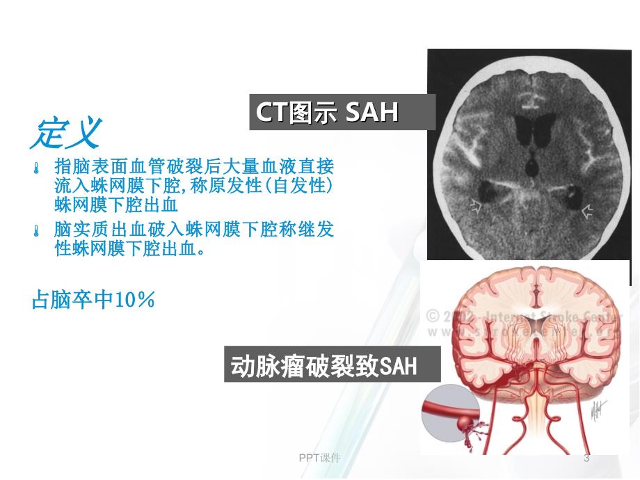 蛛网膜下腔出血--PPT课件_第3页