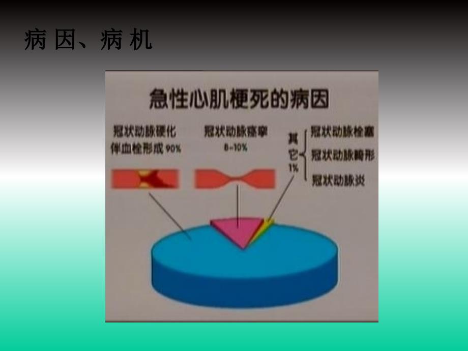 心肌梗塞PPT课件_第4页